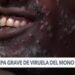 La cepa más grave de viruela del mono llega a Estados Unidos, según los CDC
