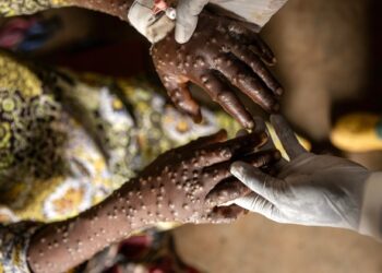 La OMS mantiene la emergencia internacional por la mpox ante el creciente número de casos