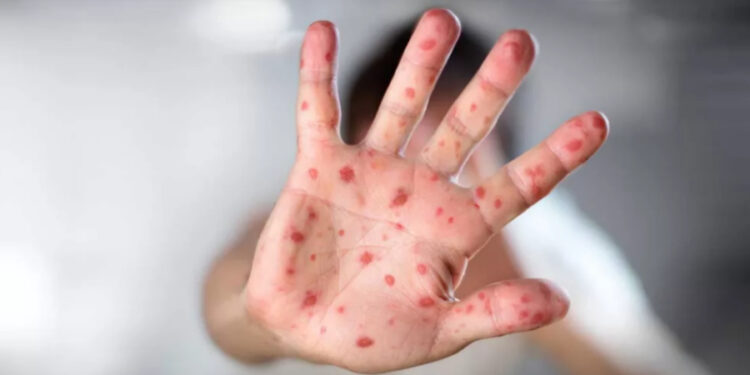 Diez países de las Américas reportan brotes de sarampión en 2025